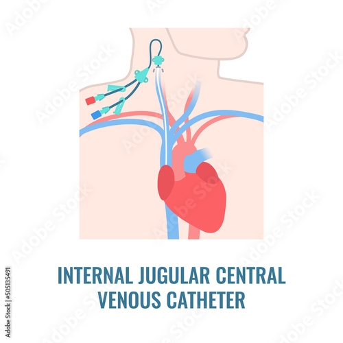Central venous catheter placed in the jugular vein. Man with CVC access device. Internal jugular venous IJV cannulation procedure. Medical vector illustration. photo