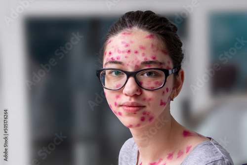 Obraz na plátně Chickenpox adult girl covered in skin inflammation.