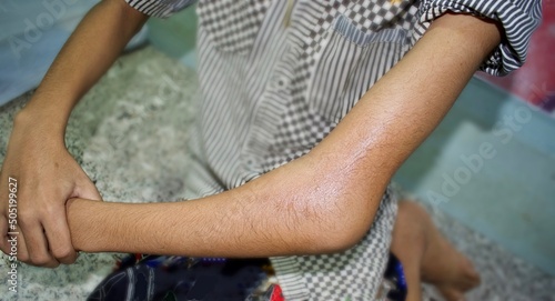 Photo Supracondylar fracture or broken elbow in Asian child