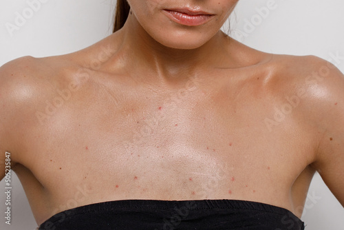 acne close-up on the female breast, problematic teenage skin photo