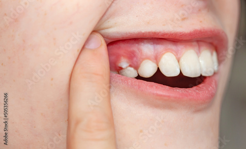 Close-up of a child's teeth: problems with teeth, teeth in two rows, replacement of baby teeth with molars.