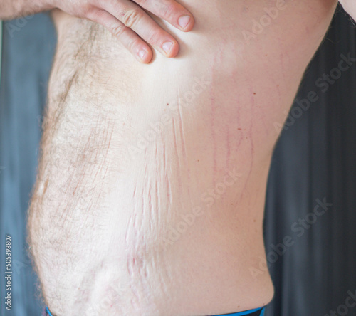 Man showing his stretch marks and loose skin after weight loss, fitness lifestyle theme.
