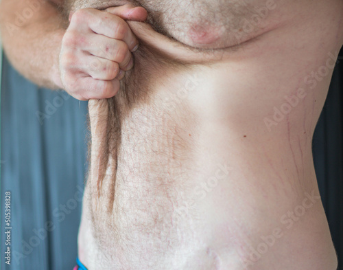 Man showing his stretch marks and loose skin after weight loss, fitness lifestyle theme.