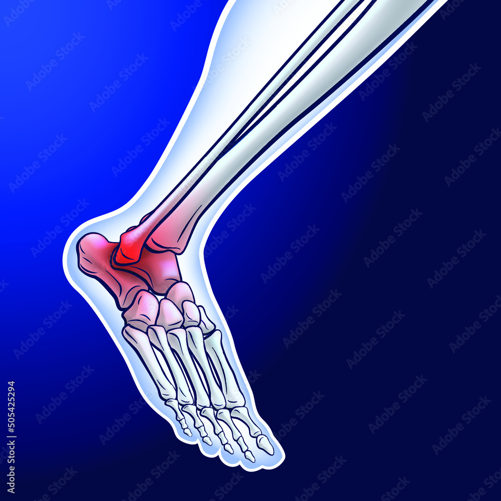 An illustration of a running ankle bone showing red dots representing a