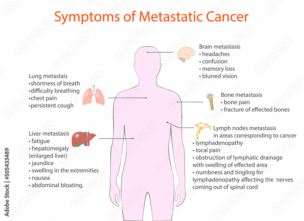 Ταπετσαρία symptoms of metastatic cancer, vector, medical