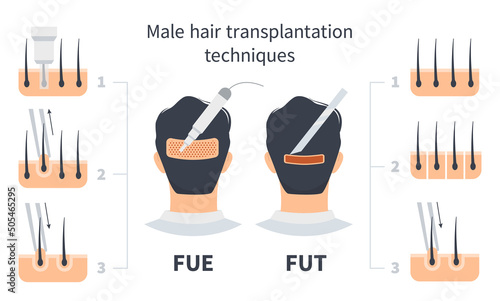 Male hair transplantation FUE and FUT comparison, stages of Follicular Unit Extraction. Treatment of baldness, alopecia and hair loss. Vector medical infographic, man's head scalp