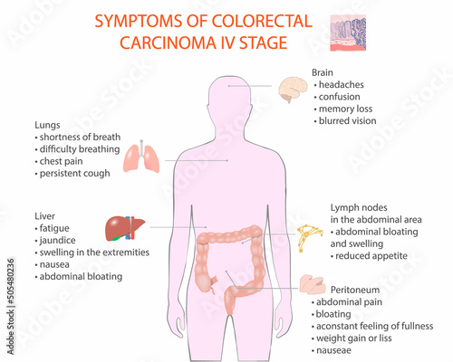 Symptoms of coloretal carcinoma IV stage, vector, medical diagram