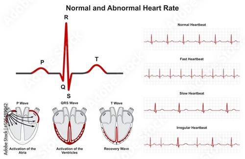 Normal and abnormal human heart beat rate infographic diagram for cardiology medical science education fast slow irregular heartbeat heartrate waves ecg sinus rhythm vector chart illustration photo