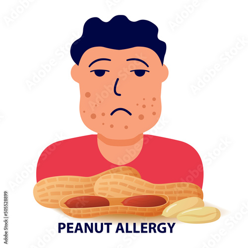 Nut allergy symptoms problem .Swollen man character.Allergic reaction to peanuts.Flat illustration vector.Isolated on a white background.