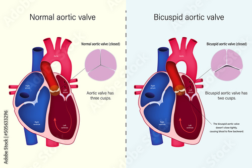 The difference of normal heart valve and bicuspid aortic valve vector. Congenital heart disease. Backward flow of blood (aortic valve regurgitation). photo