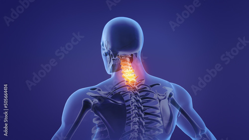Animation of a painful neck	 photo