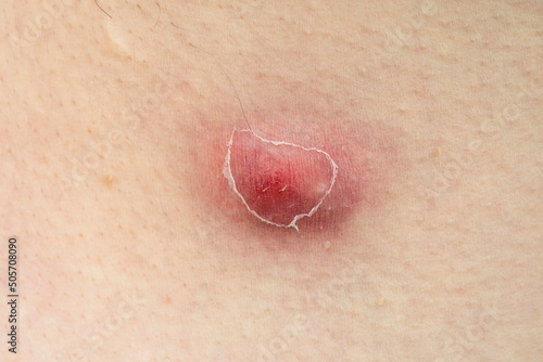 фотографія Close-up of furuncle, acne, pimple with pus under skin
