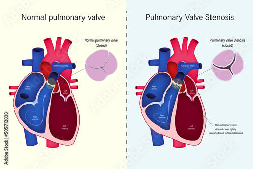 The difference of normal pulmonary valve and pulmonary valve stenosis vector. Congenital heart disease.