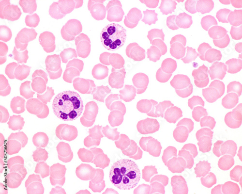 Human blood smear. Neutrophil hypersegmentation photo