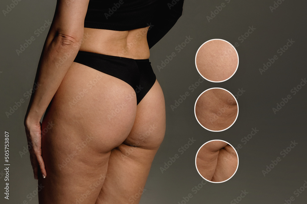 Buttocks and hips woman with cellulite and stretch marks close-up before liposuction procedure and cosmetic therapy - obrazy, fototapety, plakaty 