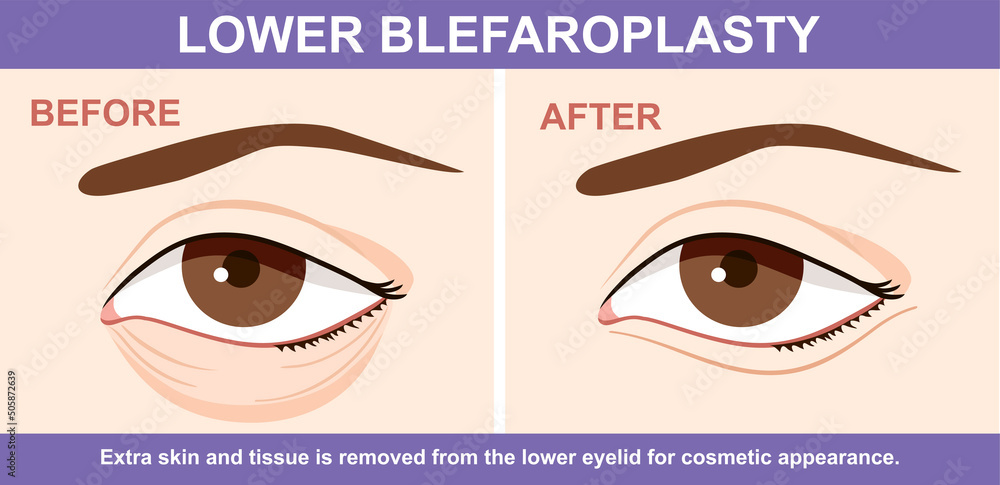 Ταπετσαρία Lower Blepharoplasty of eyelid , before and after