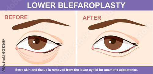 Lower Blepharoplasty of eyelid , before and after. Vector illustration with plastic eyelid surgery. Infographics with icons of plastic surgery procedures. photo