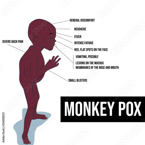 Monkeypox, or monkeypox, is a jungle zoonosis with incidental human infections.