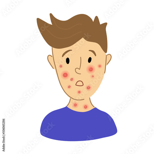 Male suffering from new virus Monkeypox. kid face sick with chickenpox pox virus infection. flat character portrait. Red rash on face - symptoms of smallpox chickempox, monkeypox photo