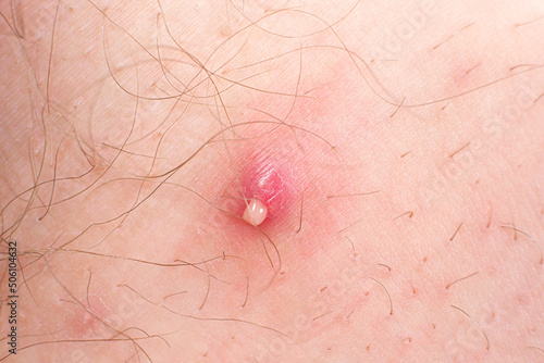 Macro photo of a large red pimple with the release of pus on human skin photo