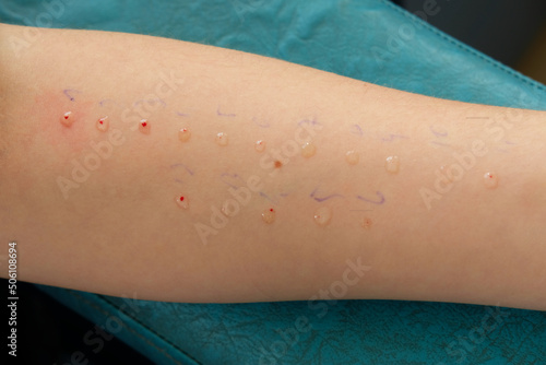 allergy skin test close up photo