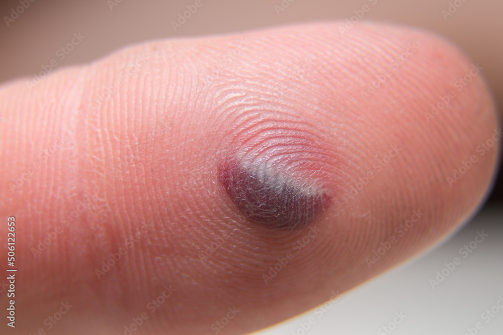Fototapeta premium Blood blister under the thumb skin. Caucasian young man finger on white background.