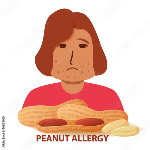 Nut allergy symptoms problem .Swollen man character.Allergic reaction to peanuts girl.Flat illustration vector.Isolated on a white background.
