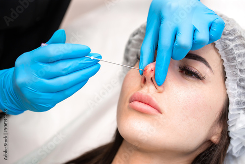 Cosmetic procedure for non-surgical rhinoplasty. The beautician inserts cosmetic threads into the nose with a needle to reshape the nose  close-up. Plastic surgery  cosmetology