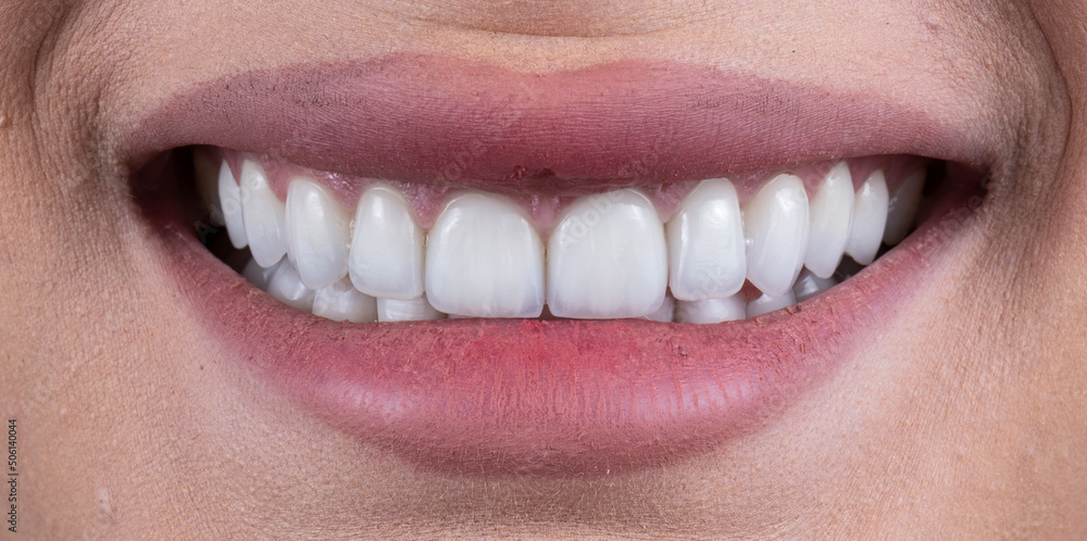 Obraz premium press ceramic crowns and veneers