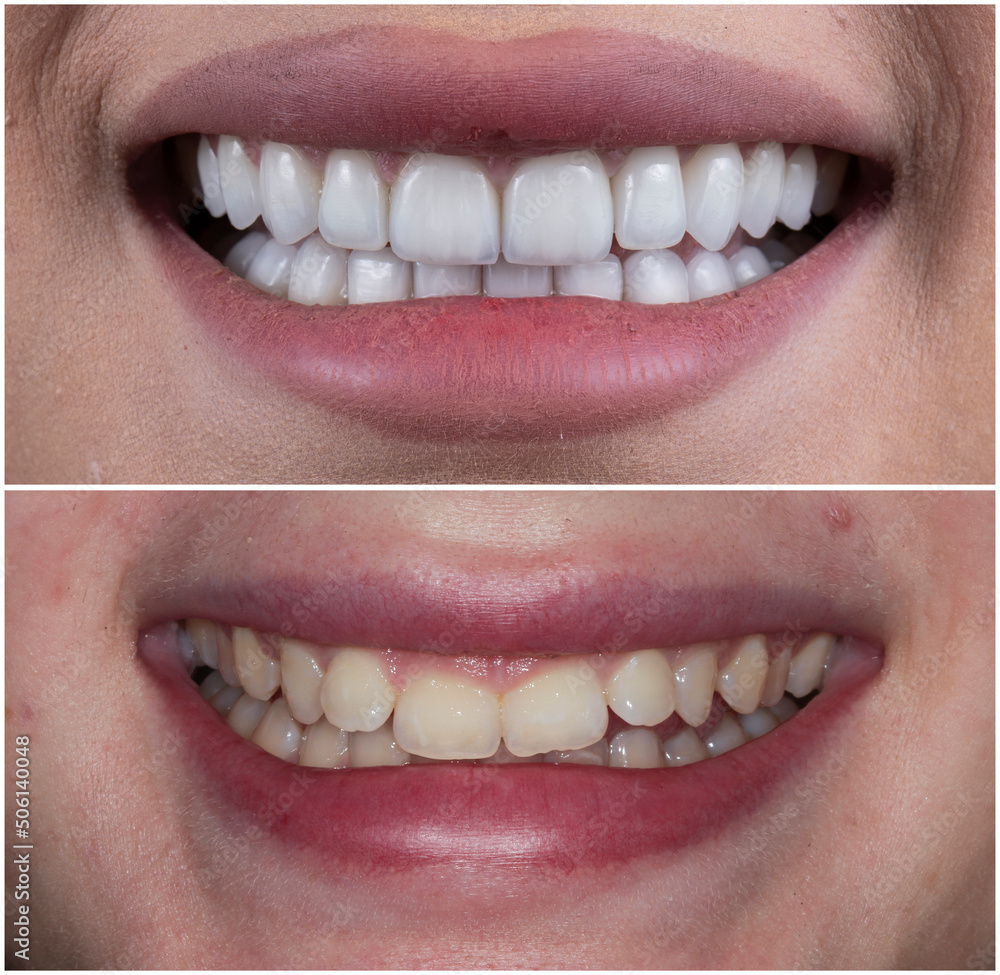 Obraz premium press ceramic crowns and veneers