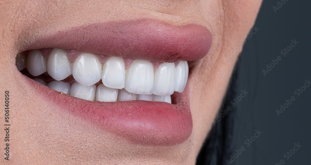 Obraz premium press ceramic crowns and veneers