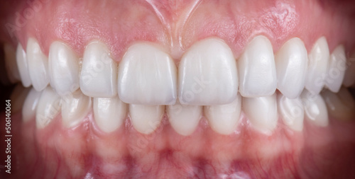 press ceramic crowns and veneers