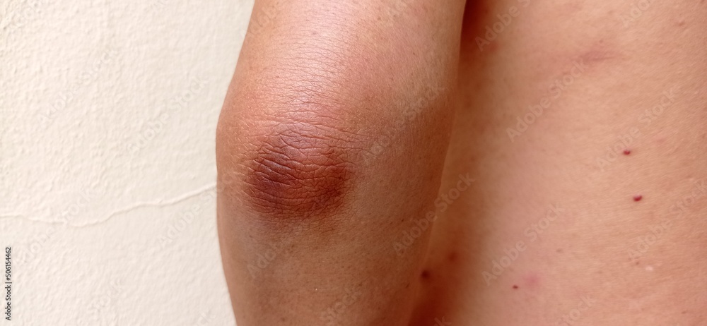 Dark skin of men's elbows. Dark skin of men's elbows.