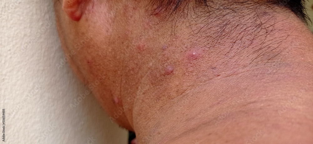 Naklejka premium Man with inflammatory acne on the nape of the neck.