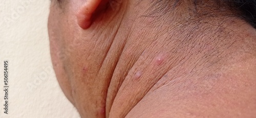 Man with inflammatory acne on the nape of the neck. photo