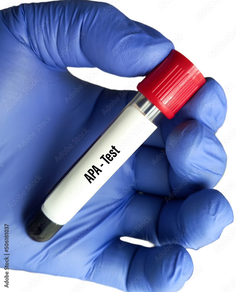 Blood sample tube for APA (Antiphospholipid antibodies) test. To