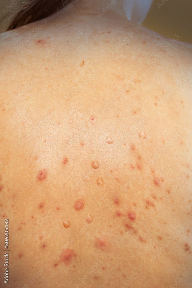 monkeypox infection virus on a woman's skin. Pandemic Monkeypox is a rare disease caused by a virus. Infection in Africa, Europe. monkeypox infection virus on a woman's skin. Pandemic Monkeypox is a rare disease caused by a virus. Infection in Africa, Europe.