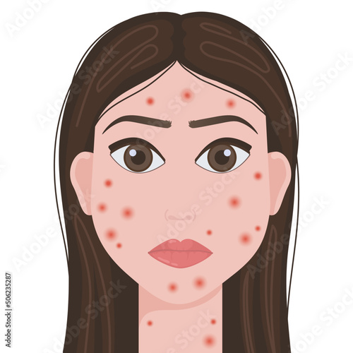 Smallpox virus. Vector illustration of smallpox virus. Monkeypox. Vector illustration of a person affected by smallpox.