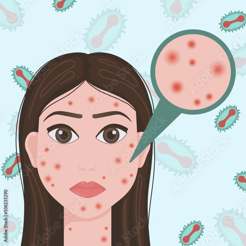Smallpox virus. Vector illustration of smallpox virus. Monkeypox. Vector illustration of a person affected by smallpox.