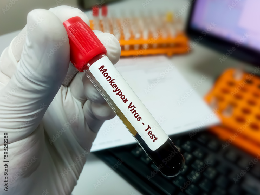 Blood sample for Monkeypox virus test. It is also known as the Moneypox virus, a double-stranded DNA virus and member of Poxviridae family. Blood sample for Monkeypox virus test. It is also known as the Moneypox virus, a double-stranded DNA virus and member of Poxviridae family.