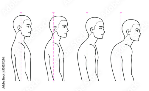 Spine kyphosis progression stages