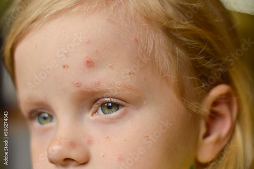 Fotografie Close-up of a Caucasian girl with pimples and ulcers on her face