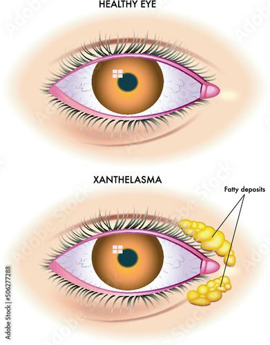 Medical illustration shows the comparison between a normal eye and one affected by xanthelasma. photo