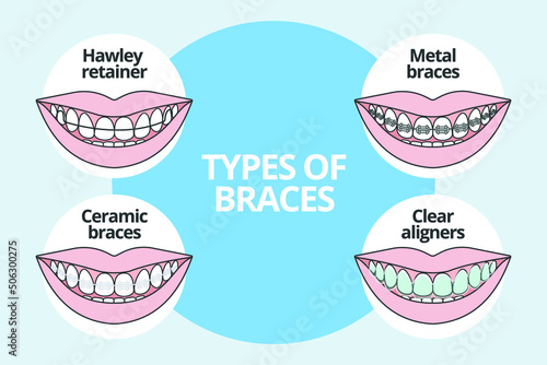 Types Of Braces, orthodontics, vector illustration