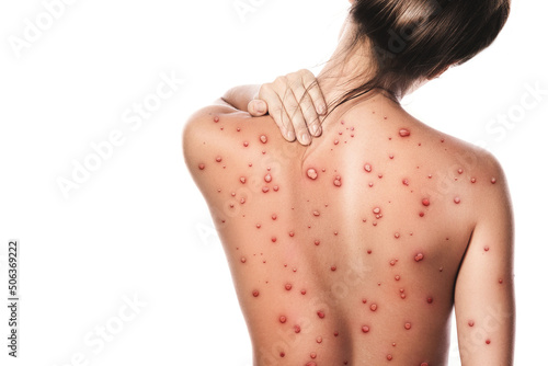 Female back affected by blistering rash because of monkeypox or other viral infectio photo