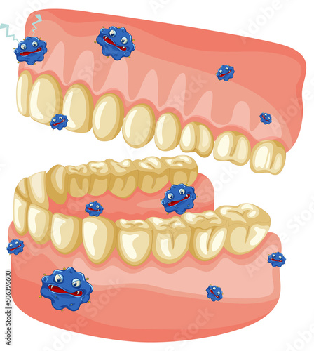Yellow human teeth model with bacteria