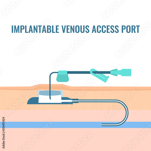Implantable venous access port cross section illustration