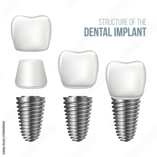 Realistic dental implant structure with all parts: crown, abutment, screw. Vector illustration