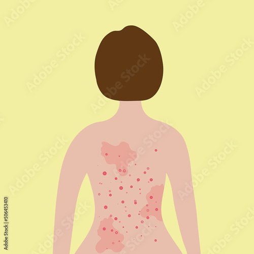 Acne on female back. Allergy treatment, skin problems concept. 