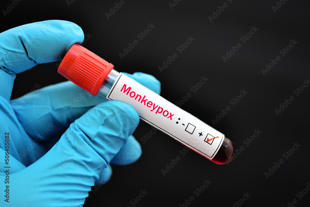 Obraz premium Blood sample tube positive with Monkeypox virus, new epidemic disease in 2022